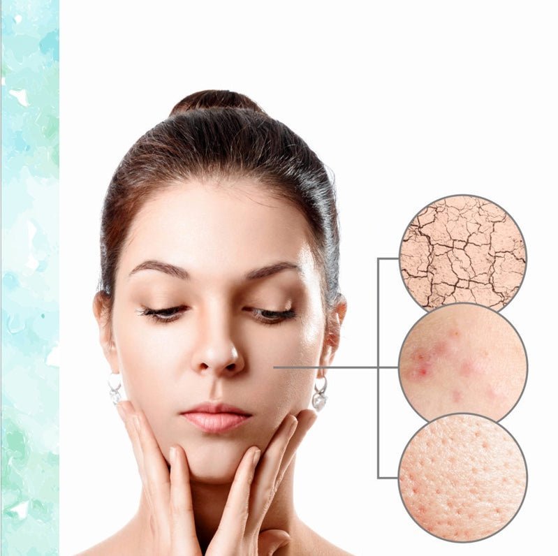 Stress can cause acne and wrinkles - Val Supplements